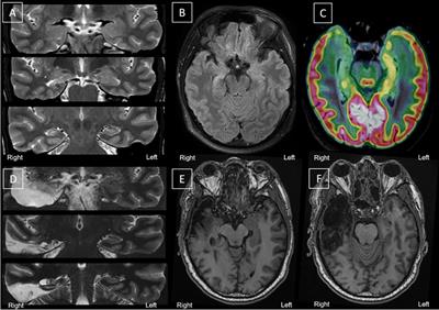 Post-traumatic Stress Disorder With Flashbacks of an Old Childhood Memory Triggered by Right Temporal Lobe Epilepsy Surgery in Adulthood